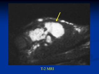 T-2 MRI
 
