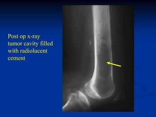 Post op x-ray
tumor cavity filled
with radiolucent
cement
 