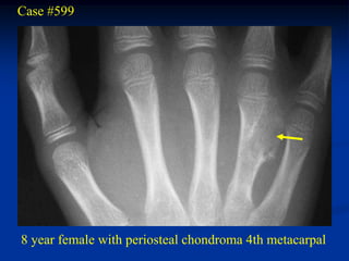 Case #599




8 year female with periosteal chondroma 4th metacarpal
 