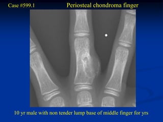 Case #599.1              Periosteal chondroma finger




  10 yr male with non tender lump base of middle finger for yrs
 