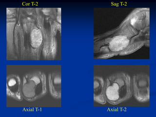 Cor T-2      Sag T-2




Axial T-1   Axial T-2
 