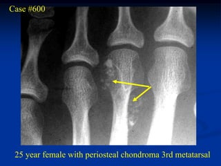 Case #600




 25 year female with periosteal chondroma 3rd metatarsal
 