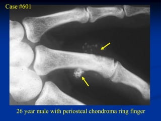 Case #601




   26 year male with periosteal chondroma ring finger
 
