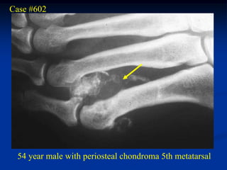 Case #602




 54 year male with periosteal chondroma 5th metatarsal
 