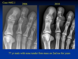Case #602.1      2006                           2010




     77 yr male with none tender firm mass on 2nd toe for years
 