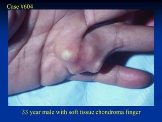 Case #604




     33 year male with soft tissue chondroma finger
 
