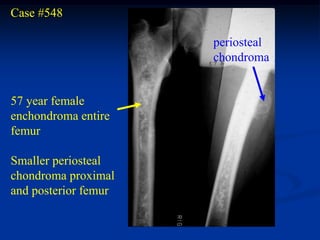 Case #548

                      periosteal
                      chondroma


57 year female
enchondroma entire
femur

Smaller periosteal
chondroma proximal
and posterior femur
 