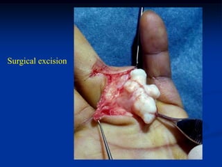 Surgical excision
 