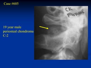 Case #605




19 year male
periosteal chondroma
C-2
 