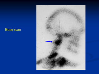 Bone scan
 