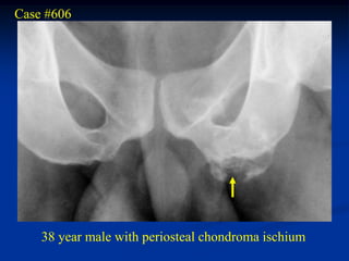 Case #606




    38 year male with periosteal chondroma ischium
 