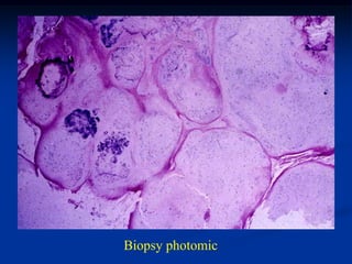 Biopsy photomic
 