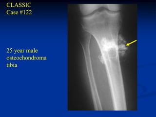 CLASSIC
Case #122




25 year male
osteochondroma
tibia
 