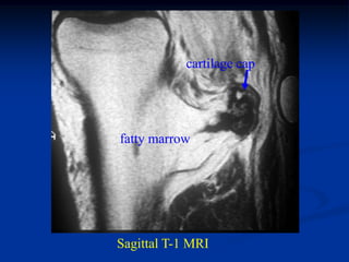cartilage cap




fatty marrow




Sagittal T-1 MRI
 