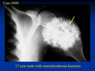 Case #608




       17 year male with osteochondroma humerus
 