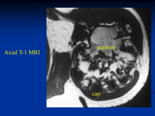 marrow
Axial T-1 MRI




                cap
 
