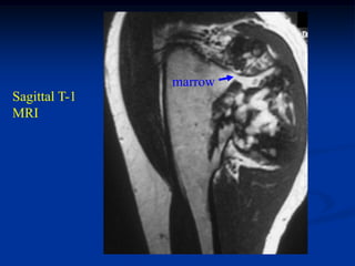 marrow
Sagittal T-1
MRI
 