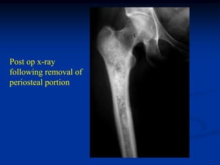 Post op x-ray
following removal of
periosteal portion
 