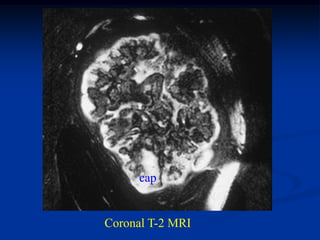 cap


Coronal T-2 MRI
 