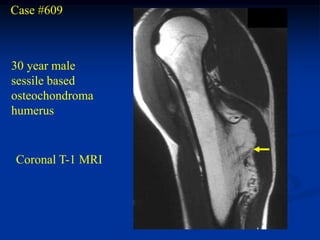 Case #609



30 year male
sessile based
osteochondroma
humerus


Coronal T-1 MRI
 