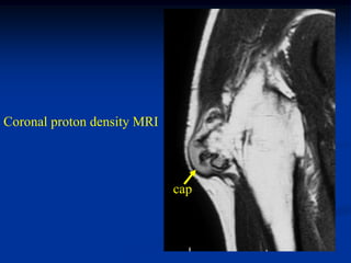 Coronal proton density MRI



                             cap
 