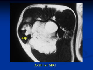cap




      Axial T-1 MRI
 