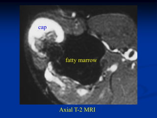 cap




        fatty marrow




      Axial T-2 MRI
 