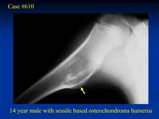 Case #610




14 year male with sessile based osteochondroma humerus
 