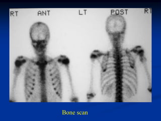 Bone scan
 