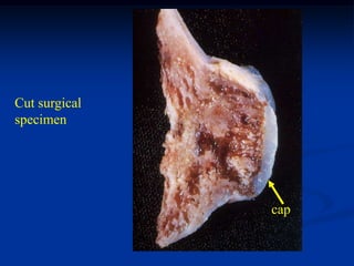 Cut surgical
specimen




               cap
 