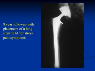 8 year followup with
placement of a long
stem THA for stress
pain symptoms
 