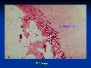 cartilage cap




Photomic
 