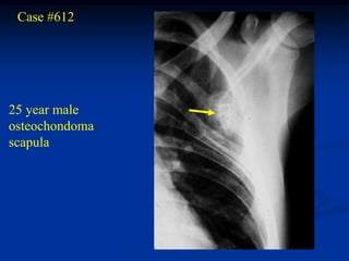 Case #612




25 year male
osteochondoma
scapula
 