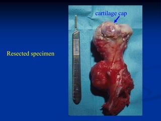 cartilage cap




Resected specimen
 