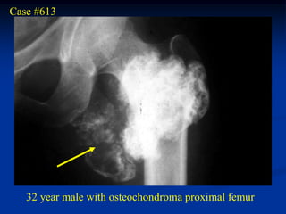 Case #613




   32 year male with osteochondroma proximal femur
 