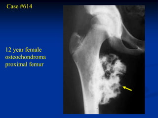 Case #614




12 year female
osteochondroma
proximal femur
 
