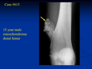 Case #615




15 year male
osteochondroma
distal femur
 