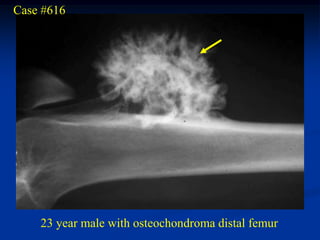 Case #616




    23 year male with osteochondroma distal femur
 