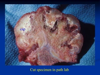 cap




      Cut specimen in path lab
 