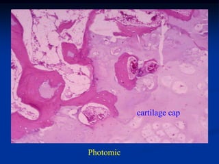 cartilage cap



Photomic
 