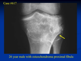 Case #617




   26 year male with osteochondroma proximal fibula
 