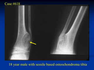 Case #618




  18 year male with sessile based osteochondroma tibia
 