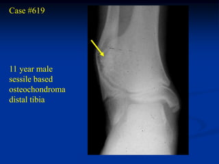 Case #619




11 year male
sessile based
osteochondroma
distal tibia
 