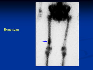 Bone scan
 