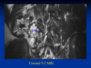 cap




Coronal T-2 MRI
 
