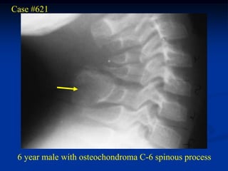 Case #621




 6 year male with osteochondroma C-6 spinous process
 