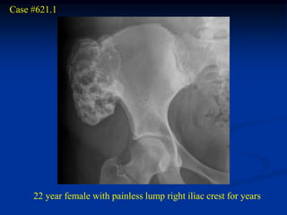 Case #621.1




     22 year female with painless lump right iliac crest for years
 