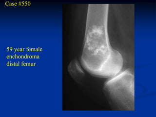 Case #550




59 year female
enchondroma
distal femur
 