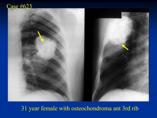 Case #623




     31 year female with osteochondroma ant 3rd rib
 