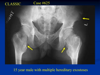 CLASSIC        Case #625




   15 year male with multiple hereditary exostoses
 